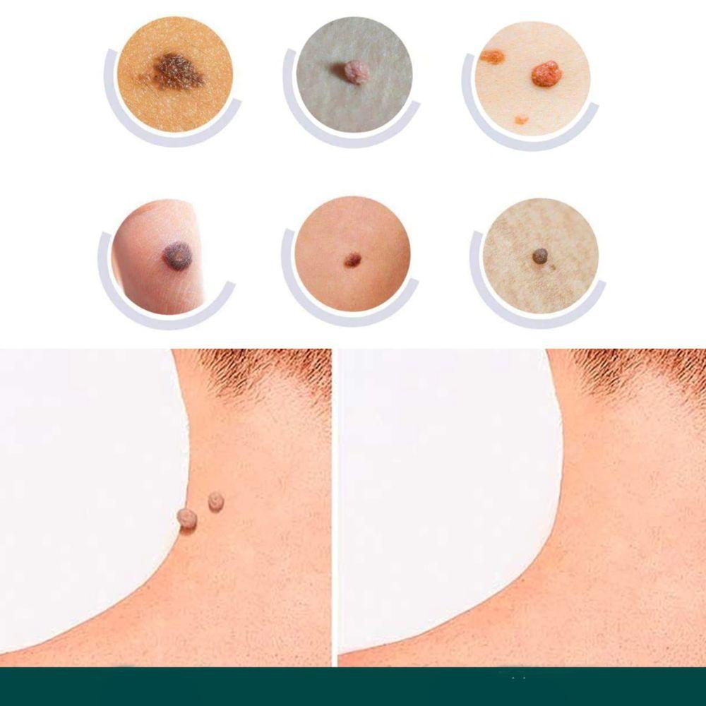 Patches de soins cutanés contre les imperfections, traitement et élimination des verrues à domicile, embellissement et soin de la peau | Sansoti