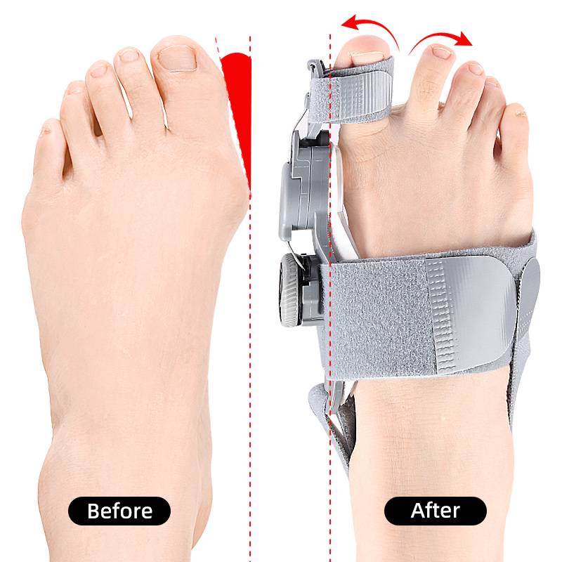 Toe Corrector with Adjustable Pressure for Hallux Valgus Treatment During the Day and at Night Comfortable Orthopedic | Sansoti